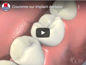 Couronne sur implant dentaire
